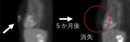 BNCT臨床研究