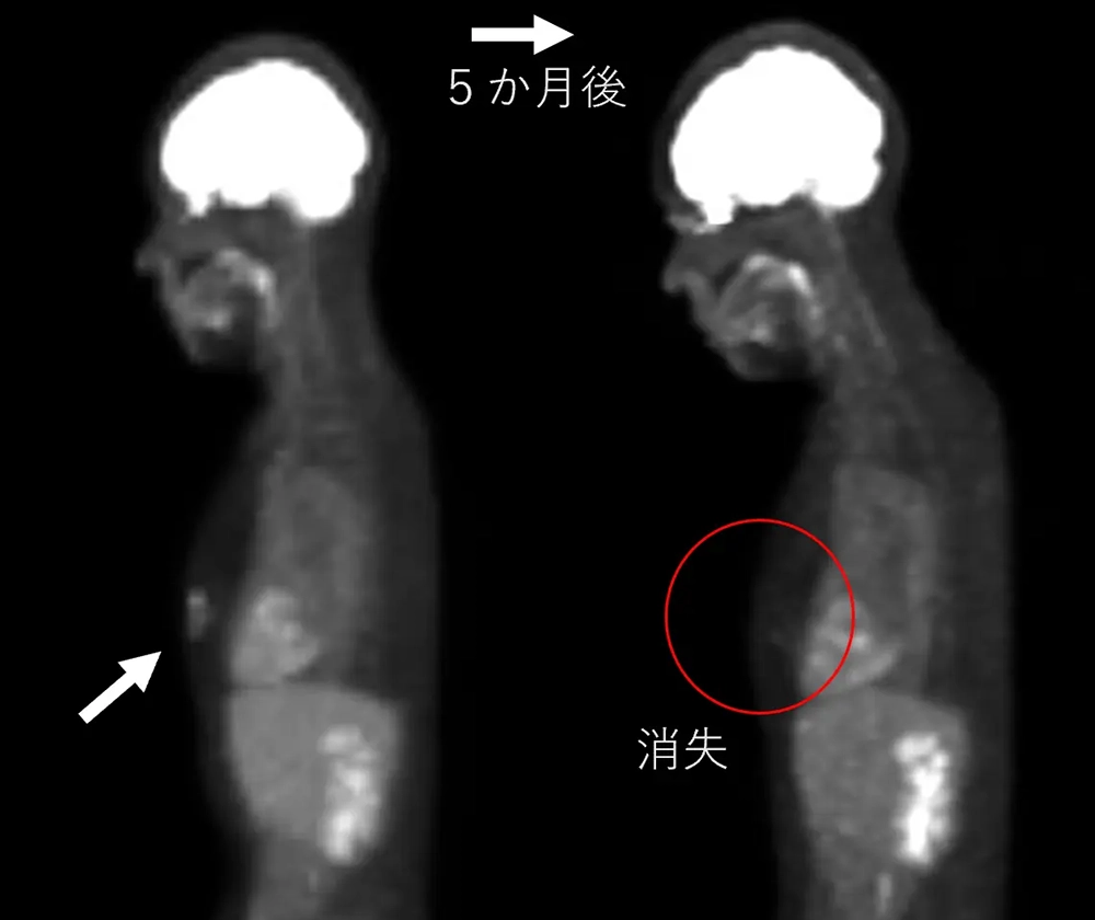 BNCT臨床研究