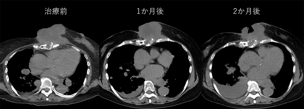 BNCT臨床研究
