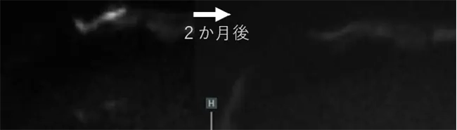 BNCT臨床研究