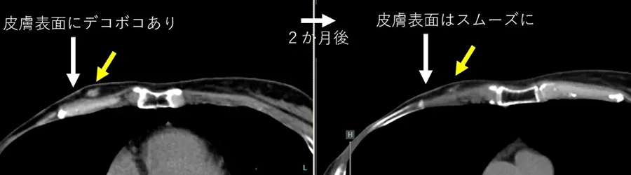 BNCT臨床研究