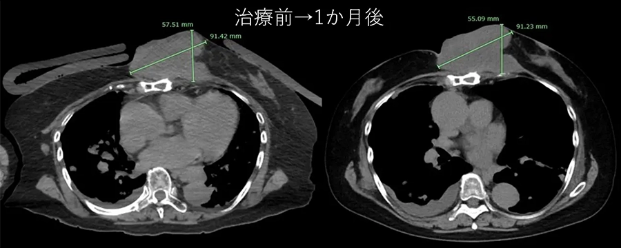 BNCT臨床研究