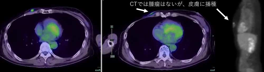 BNCT臨床研究