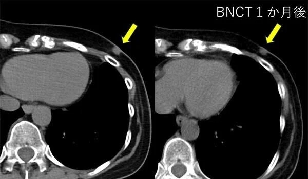 BNCT臨床研究