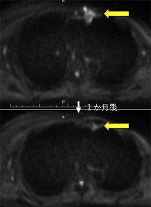 BNCT臨床研究