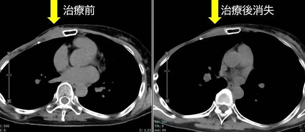BNCT臨床研究