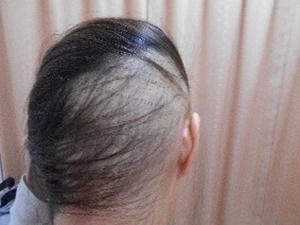 BNCT臨床研究