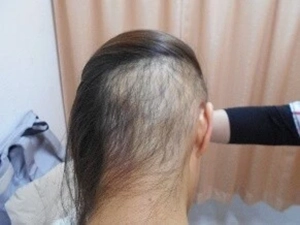 BNCT臨床研究