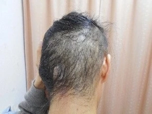 BNCT臨床研究