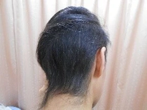 BNCT臨床研究