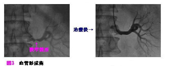 血管形成術の治療