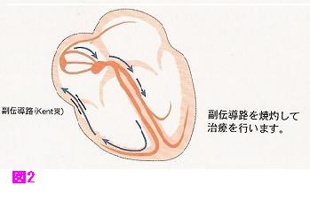 ＷＰＷ症候群に生じる房室回帰性頻拍の図