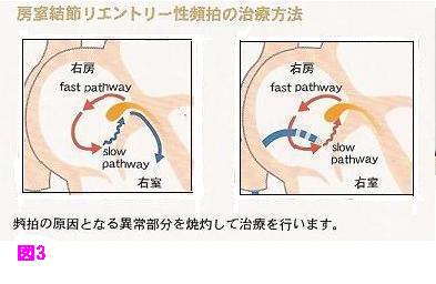 房室結節リエントリー性頻拍の治療方法の図