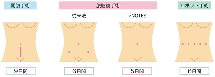 婦人科手術の4つの方法