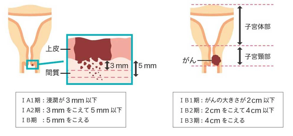 子宮頚がんの進行期 Ⅰ期