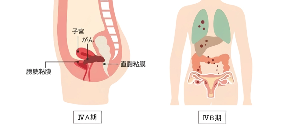 子宮頚がんの進行期 Ⅳ期