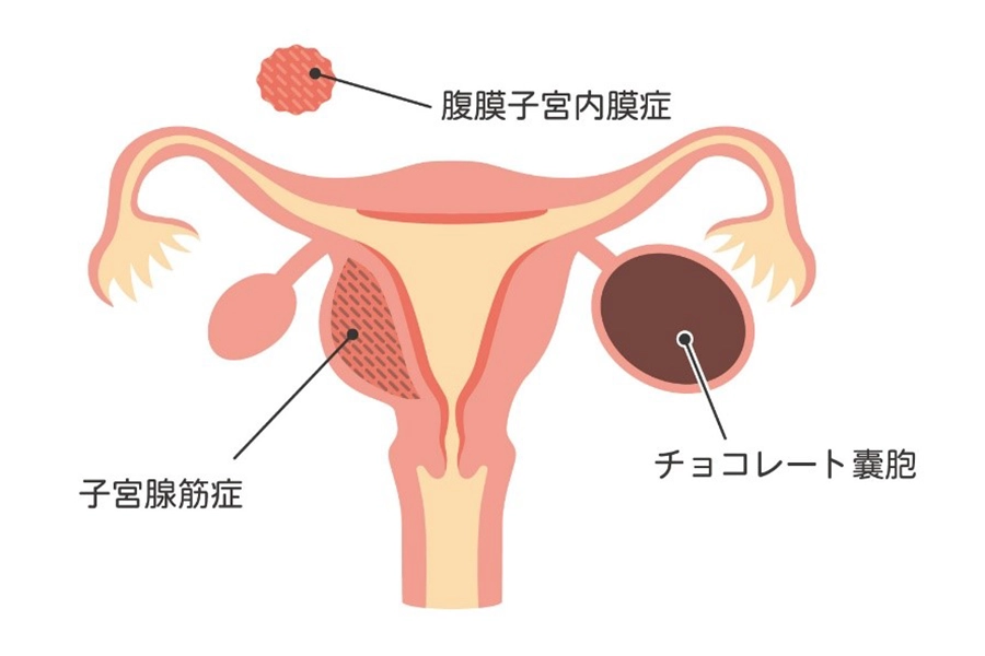 子宮内膜症の症状
