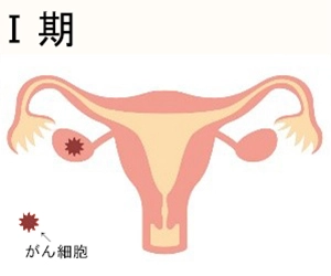 卵巣がんの進行期 Ⅰ期