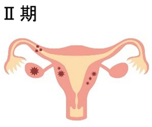 卵巣がんの進行期 Ⅱ期