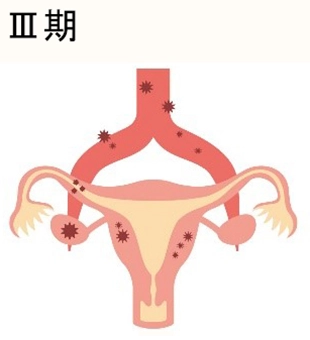 卵巣がんの進行期 Ⅲ期
