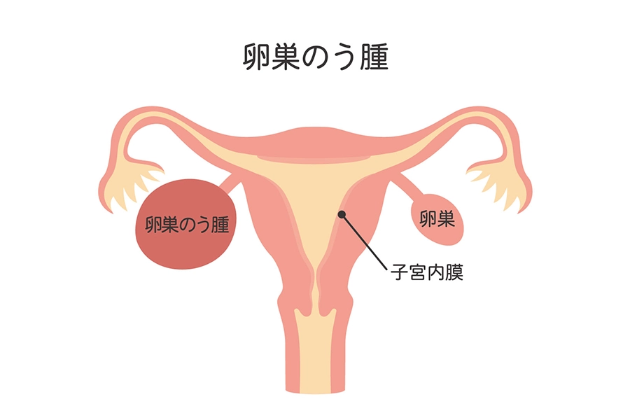 卵巣腫瘍の症状