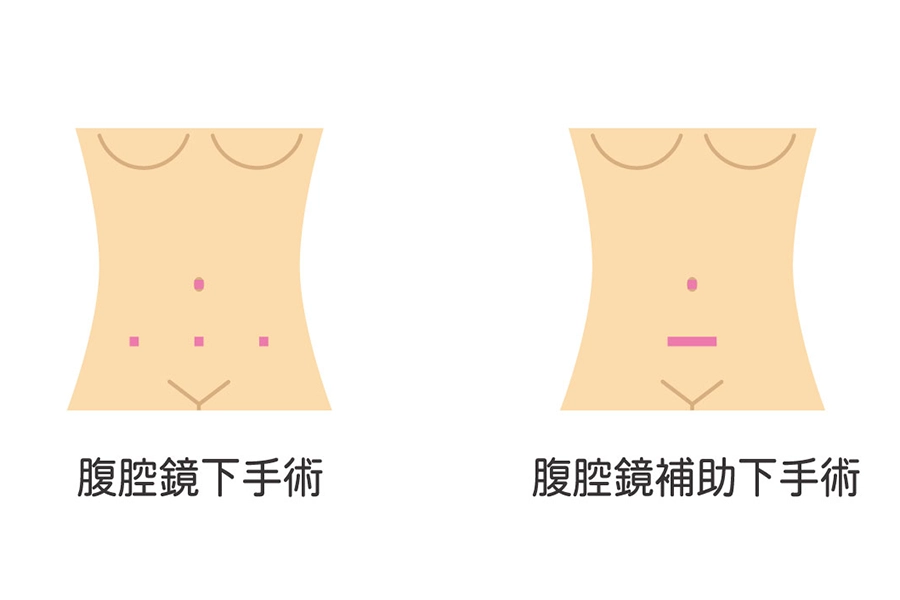 卵巣腫瘍の手術療法