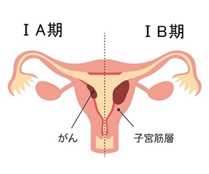 子宮体がんの進行期 Ⅰ期