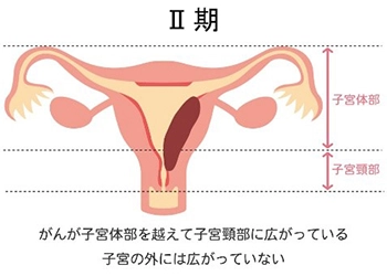 子宮体がんの進行期 Ⅱ期