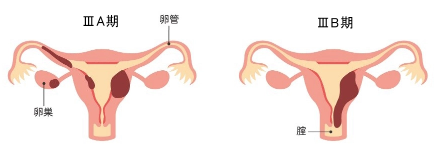 子宮体がんの進行期 Ⅲ期