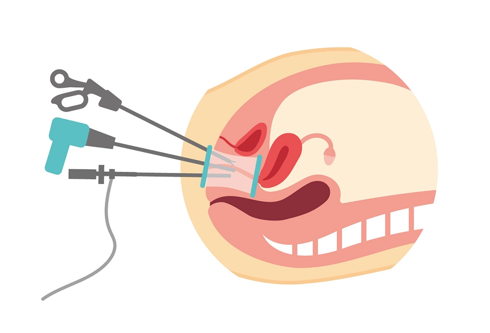 vNOTES：経腟的腹腔鏡手術