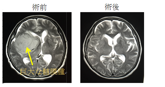 髄膜腫の術前・術後画像