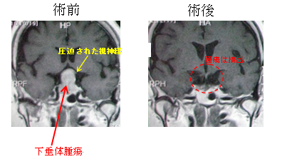下垂体腫瘍 ハイビジョン内視鏡手術の術前・術後画像