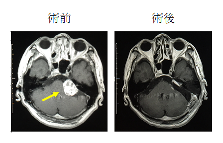聴神経腫瘍摘出術時の電気生理学的モニタリング