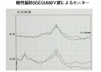 聴性脳幹反応（ABR）V波によるモニター