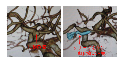 くも膜下出血
