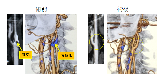 頚動脈内膜剥離術（ＣＥＡ）