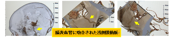 浅側頭動脈―中大脳動脈吻合術