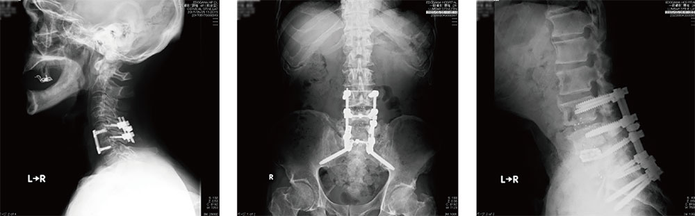 頚椎オペ後(左) 腰椎オペ後(中央) 脊椎内視鏡術