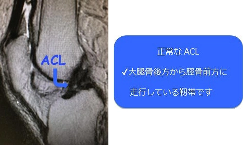 正常なACLのMRI画像
