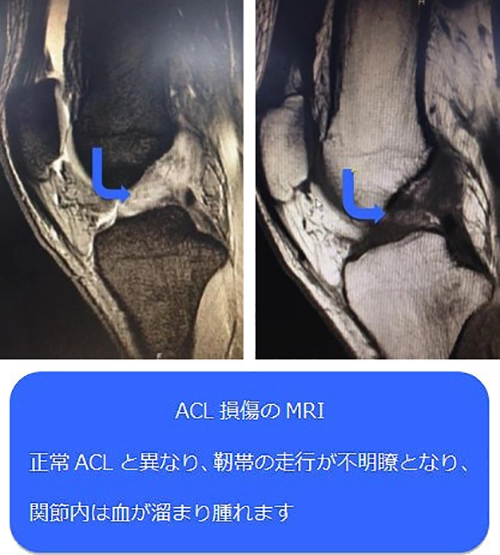 ACL損傷のMRI画像
