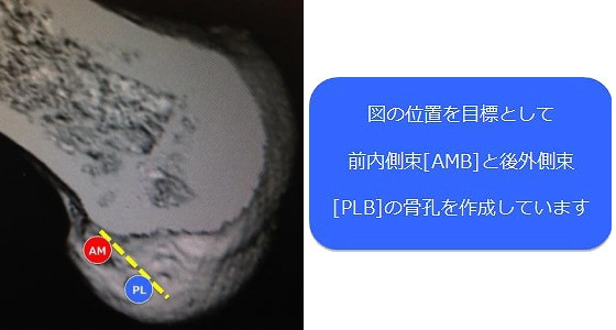 前内側束（AMB）と後外側束（PLB）の骨孔を作成している