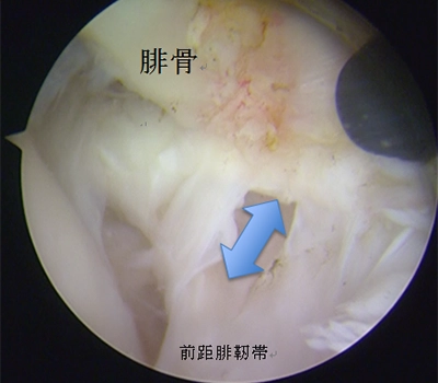 骨から靱帯が剥がれている様子