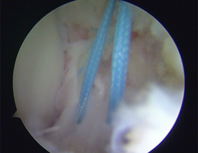 腓骨にアンカー（糸のついたビス）を挿入し、糸を剥がれた前距腓靭帯に通しているところ