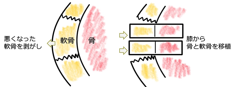 離断性骨軟骨炎（野球肘）の手術