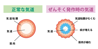 正常な気道とぜんそく発作時の気道