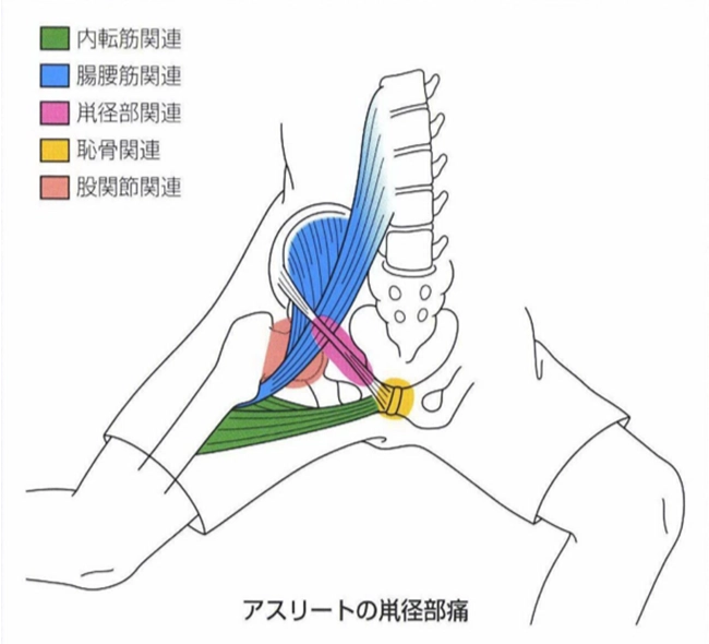 アスリートの鼡径部痛