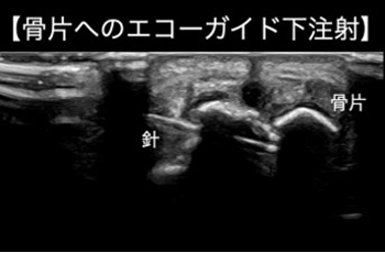 ジャンパー膝診断 画像所見