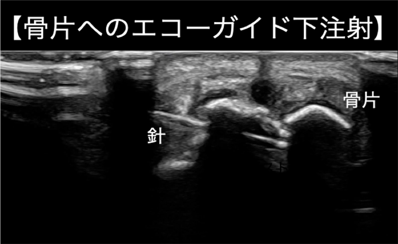 骨片へのエコーガイド下注射