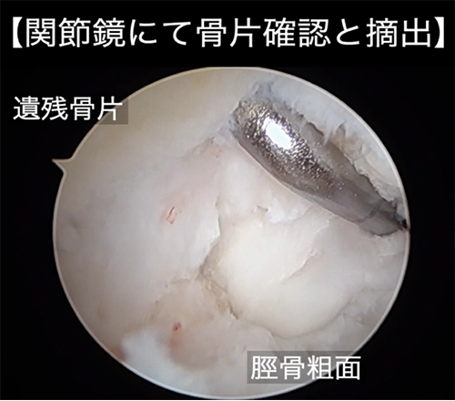 関節鏡にて骨片摘出手術の画像
