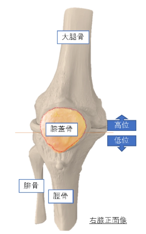 膝蓋骨脱臼の概要
